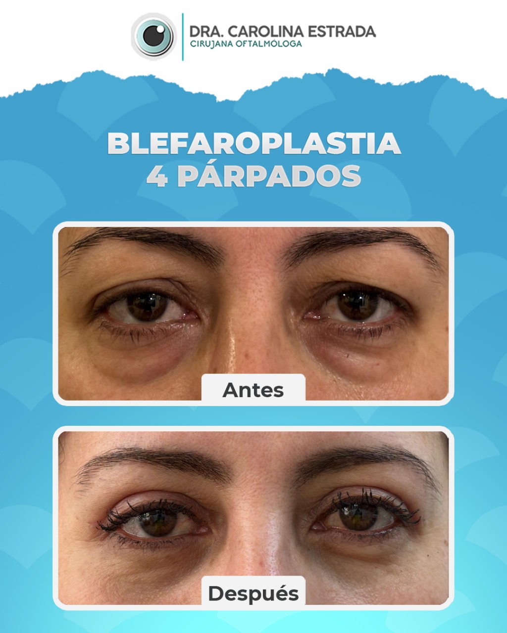 Los Principales Beneficios de la Blefaroplastia y Cómo Puedes Cambiar Tu Mirada